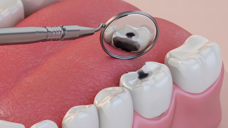 causas de las caries